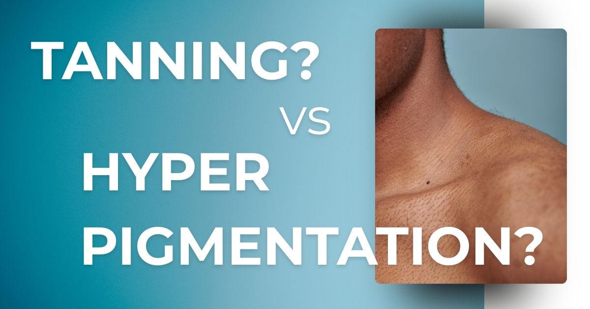 Tanning vs. Hyperpigmentation: What Niconi Tan Vanish Gluta-Kojic Skin Polish Actually Treats