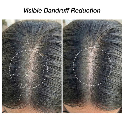 Niconi Herbal Hair (200ml) & Niconi Anti-Dandruff Shampoo (180ml) COMBO