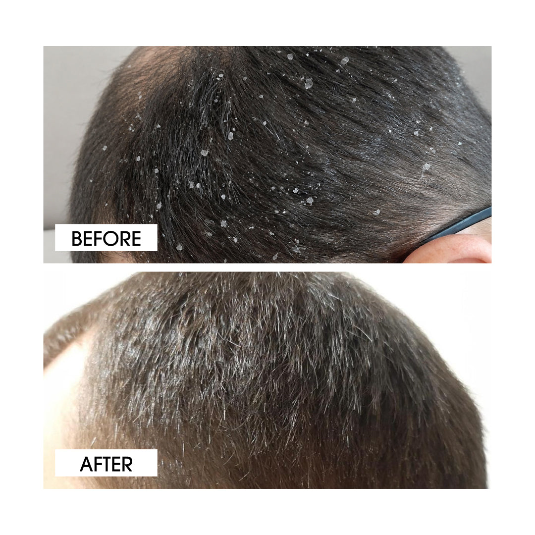 Niconi Anti-Dandruff Shampoo-(180ml)