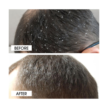 Niconi Anti-Dandruff Shampoo-(180ml)