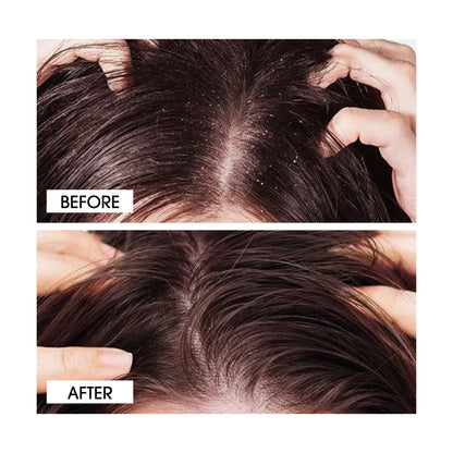 Niconi Anti-Dandruff Shampoo (180ml)